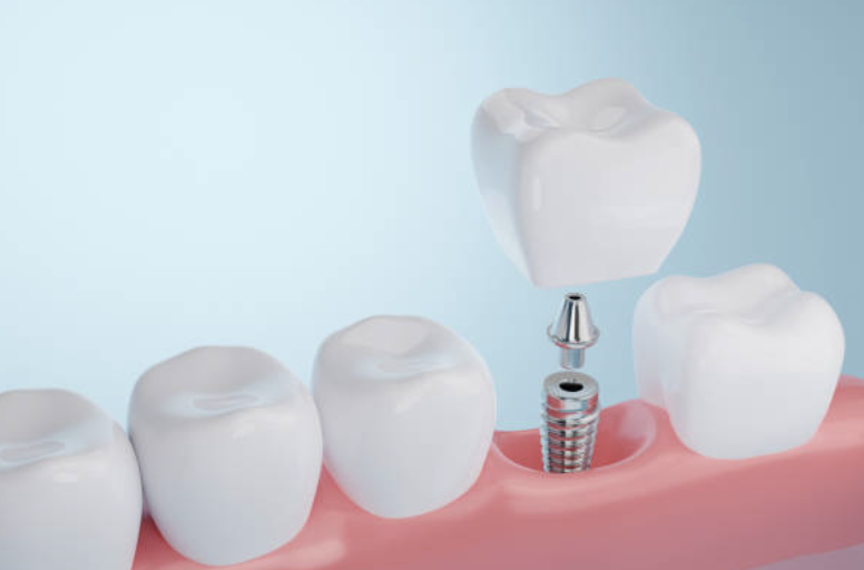 Dental Implant