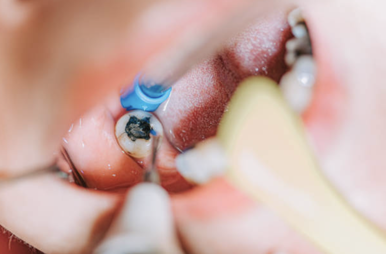 Orthodontic Treatment